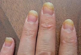 fekete köröm gomba a kézen kezelés gombák köröm kezelés zozh