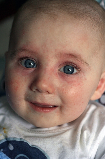 Tegye változatossá gyermeke táplálkozását ezzel csökkentheti az allergia kialakulásának kockázatát 