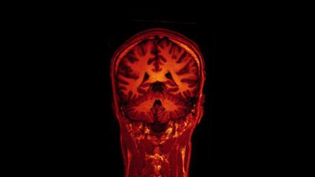 A magyar agykutatást új MRI-készülék segíti 