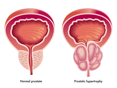 What is enlarged prostate size
