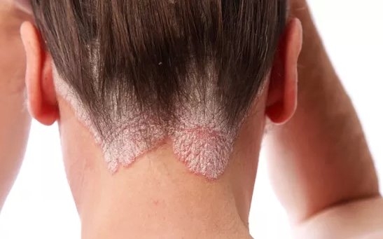 pikkelysömör kezelése puva terápia vörös durva foltok a fejbőrön